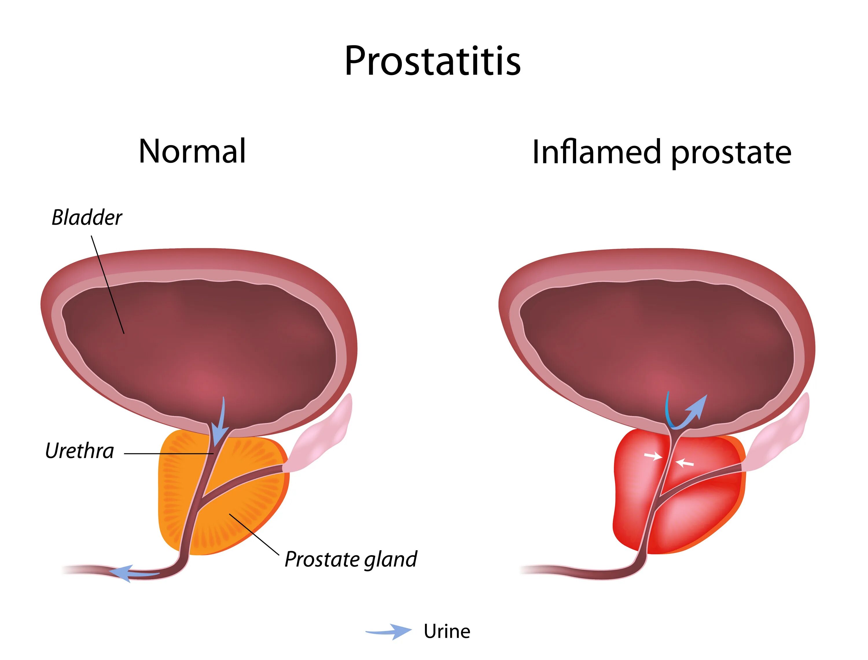 Простата это простыми словами фото у мужчин Erectile Dysfunction And Cloudy Urine Hot Sale poligraf-ti.kz