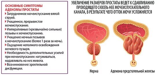 Простата это простыми словами фото у мужчин Гиперплазия предстательной железы что это лечение: найдено 77 изображений