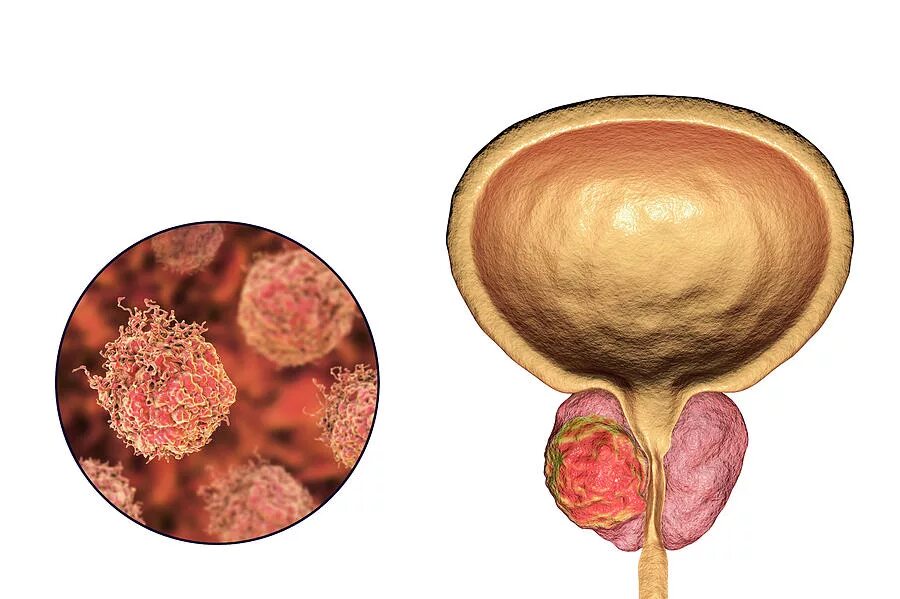 Простата симптомы фото Prostate Cancer #2 by Kateryna Kon/science Photo Library