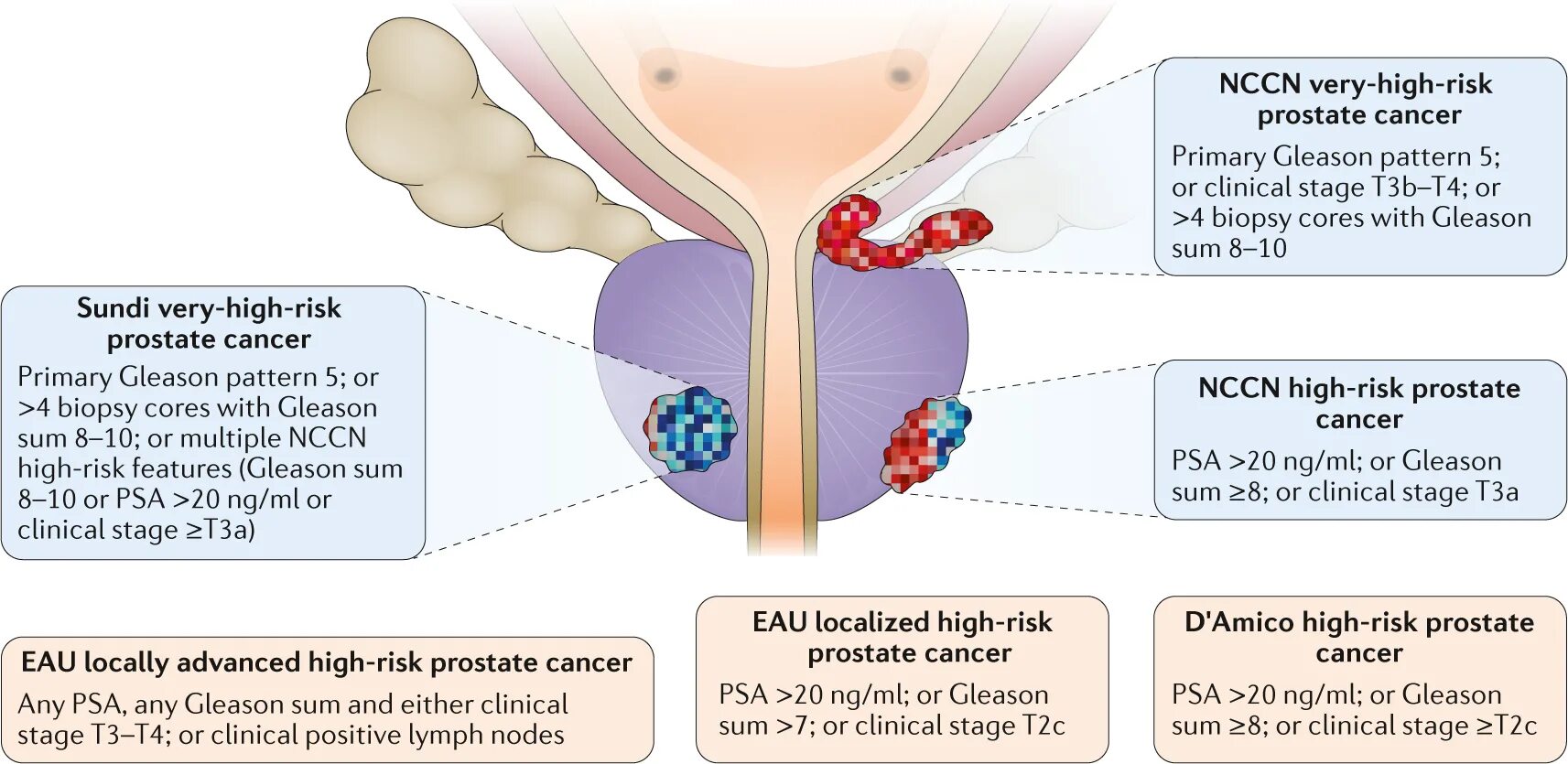 Простата симптомы фото Surgical management of high-risk, localized prostate cancer Nature Reviews Urolo