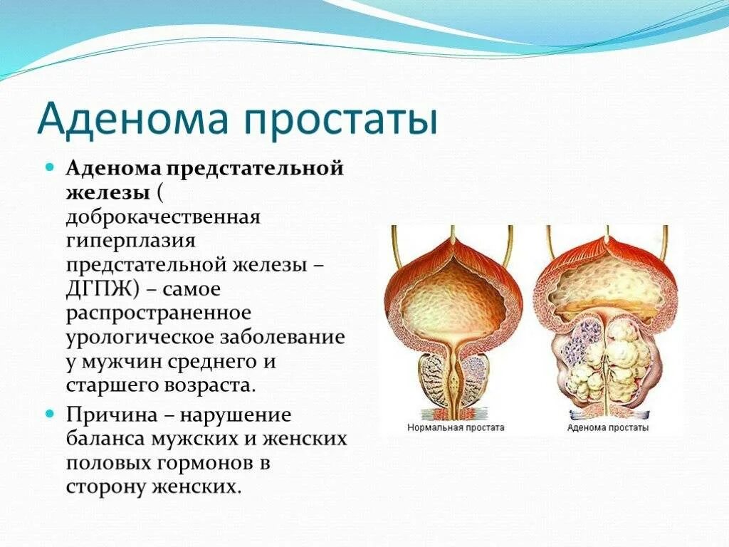 Простата симптомы фото Аденома простаты лечение сколько