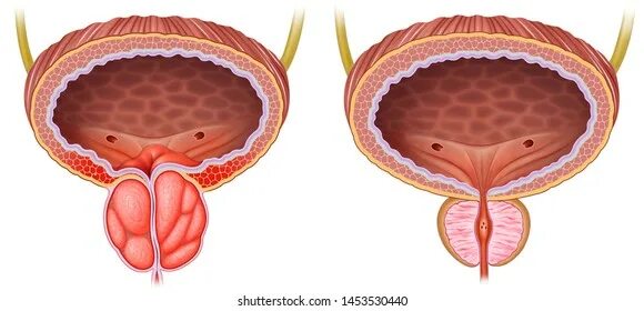 Простата симптомы фото 597 Comparing muscles: immagini, foto stock e grafica vettoriale Shutterstock