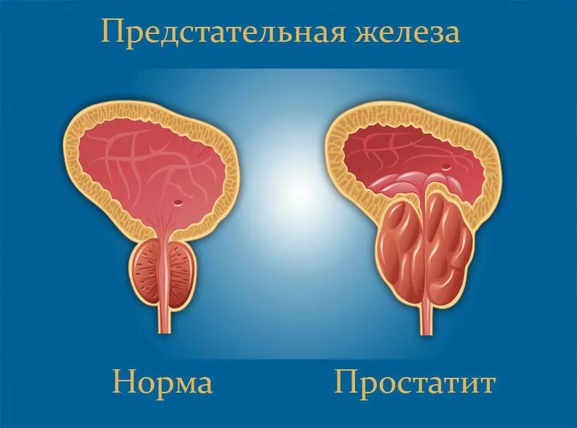 Простата симптомы у мужчин фото Хронический простатит - стоит ли бояться? Клиника Радуга