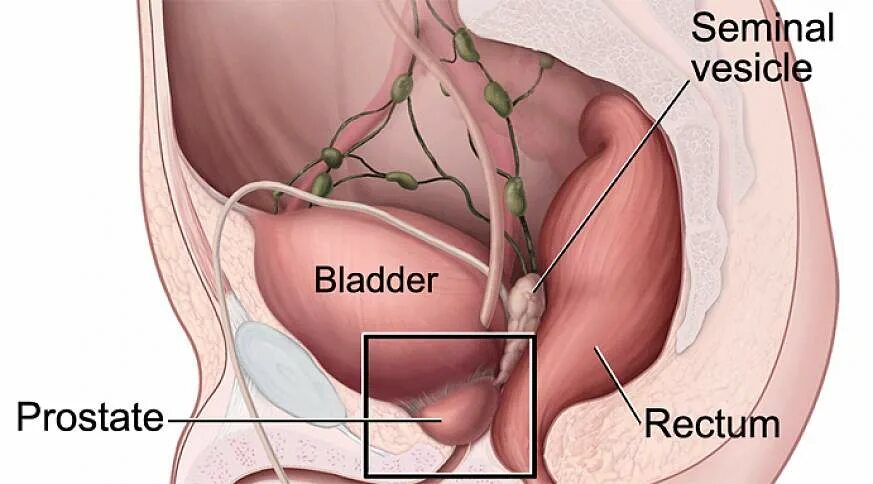 Простата снаружи фото NIH-funded study shows increased survival in men with metastatic prostate cancer