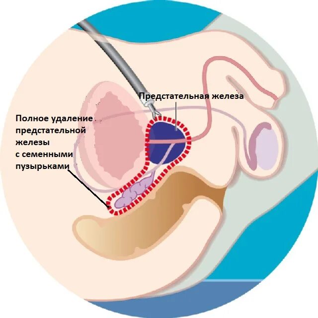 Простата снаружи фото Рак простаты / рак предстательной железы