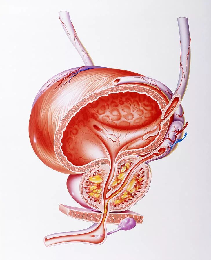 Простата у мужчин что это такое фото Illustration Showing Inflamed Prostate Gland Photograph by Science Photo Library