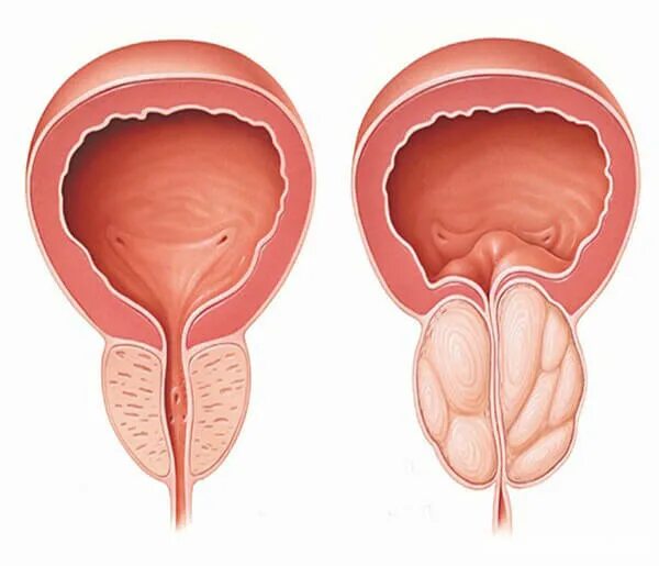 Простата у мужчин что это такое фото Гиперплазия предстательной железы: что это такое у мужчин, стадии ДГПЖ и аденомы