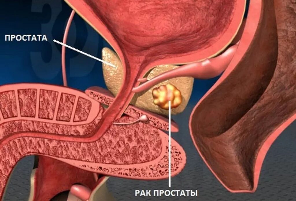 Простата у мужчин что это такое фото Рак простаты - диагностика и лечение в клинике Москвы, метро Курская и Чкаловска