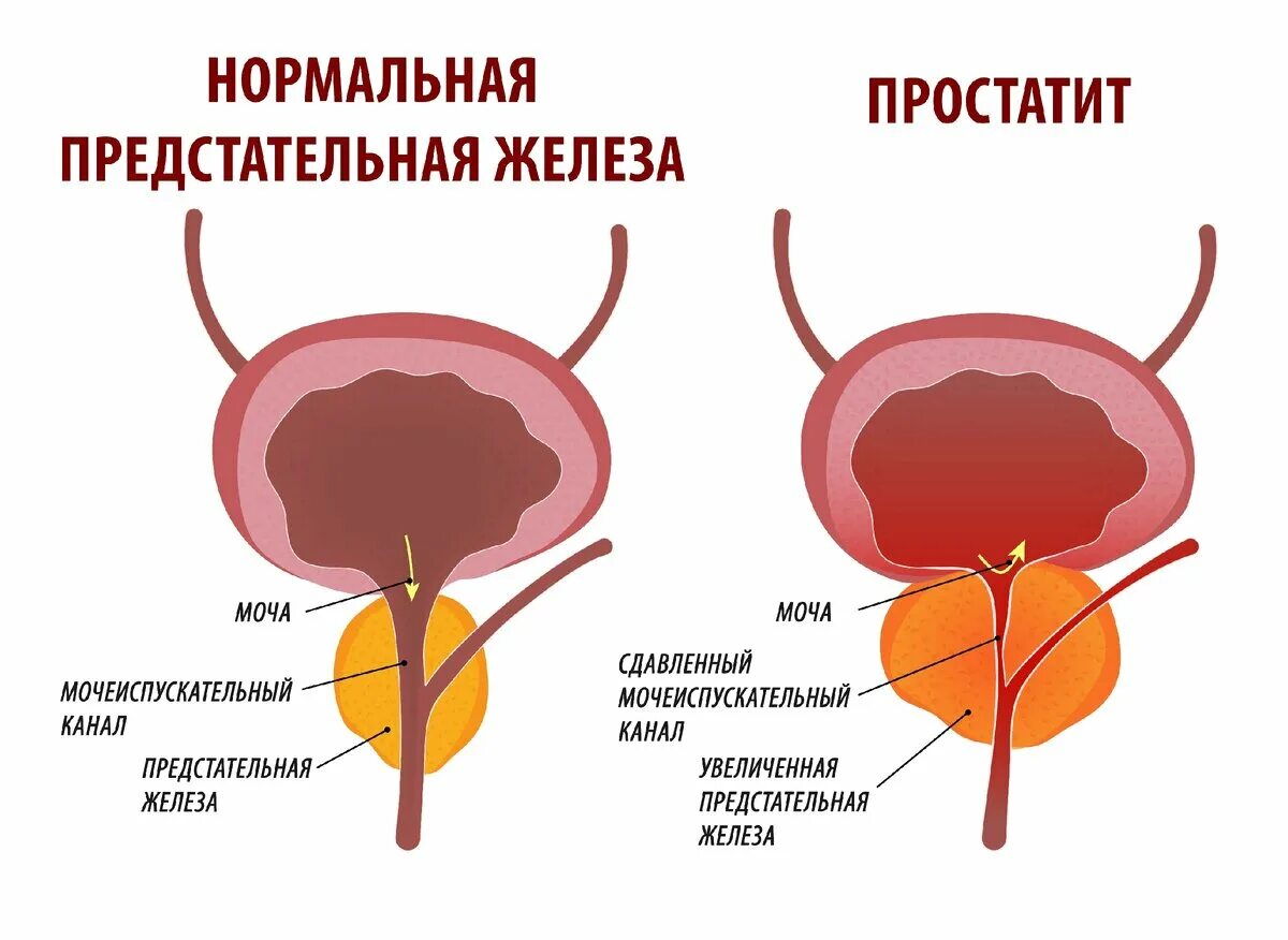 Простата у мужчин что это такое фото Как распознать простатит? Доктор ЕЛАМЕД Дзен