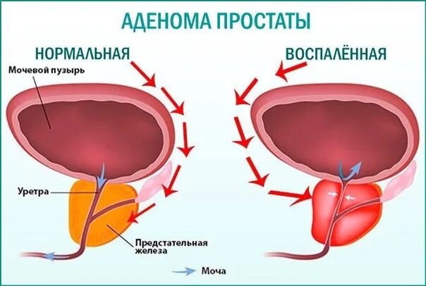 Простата у мужчин что это такое фото Аденома простаты Аденома простаты (предстательной железы) - это доброкачественно