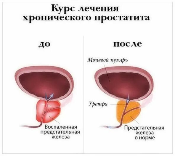 Простата у мужчин что это такое фото Топ-5 эффективных лекарств для лечения простатита Урологический центр Dr. AkNer