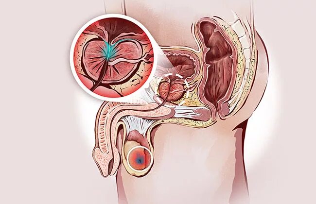 Простатит симптомы фото Prostat haqqında məlumat I Urologiya-andrologiya.az