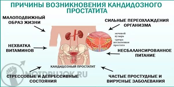 Простатит симптомы фото Как снять воспаление простаты от переохлаждения - фото презентация