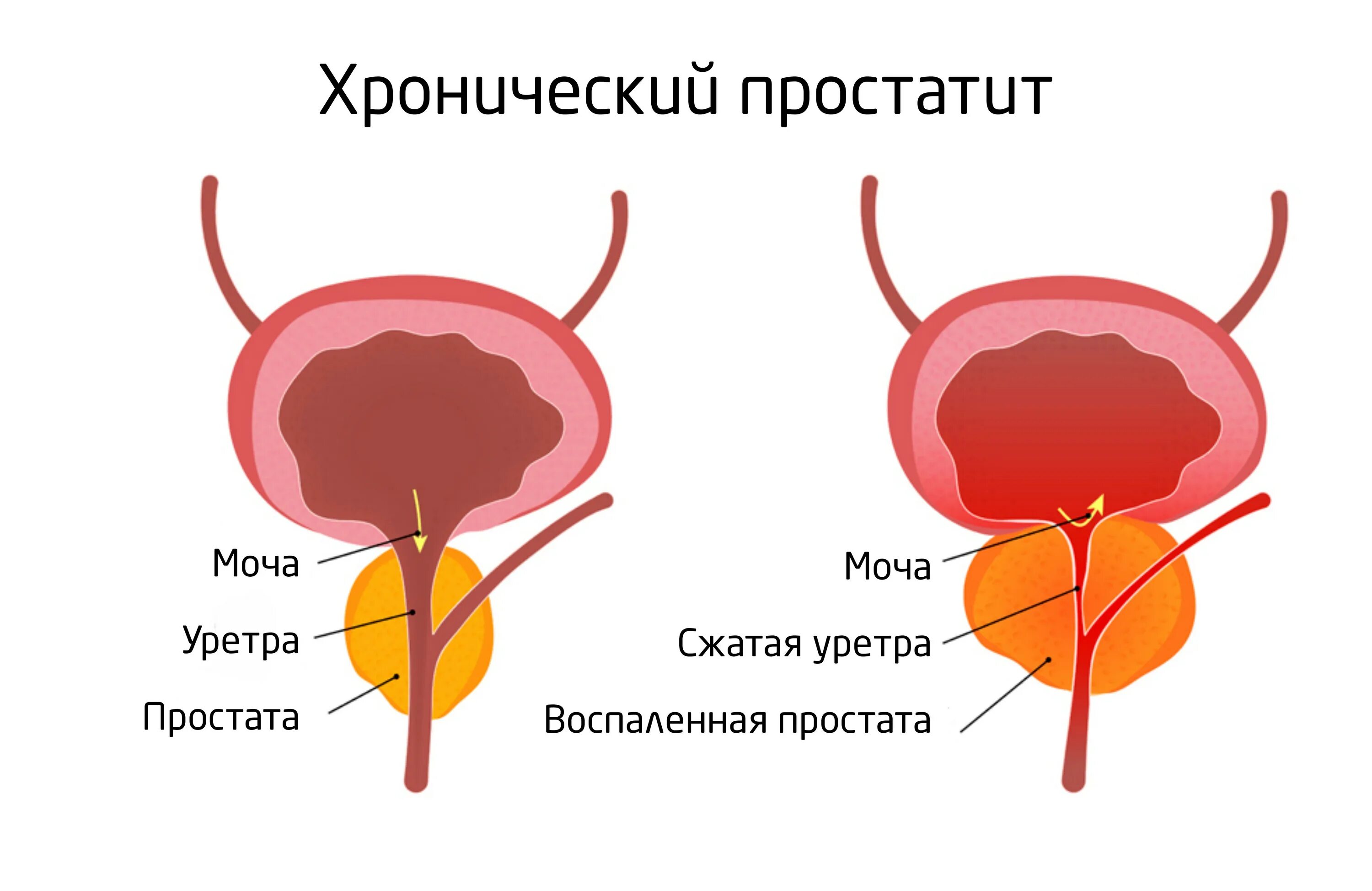 Простатит симптомы фото Хронический простатит Симптомы, причины, лечение у мужчин ᐉ Гармония здоровья