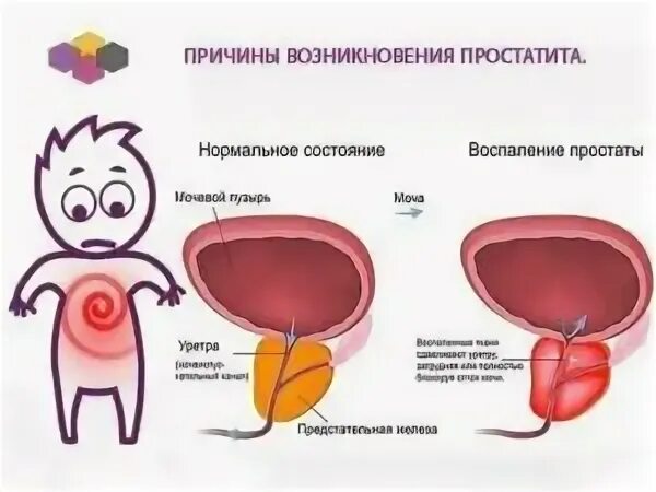 Простатит симптомы фото Триада симптомов простатита - Женское и мужское