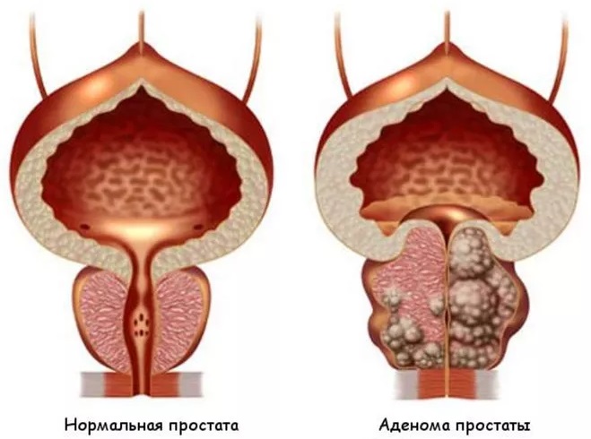 Простатит симптомы фото Аденома простаты: симптомы и лечение аденомы предстательной железы в ФНКЦ