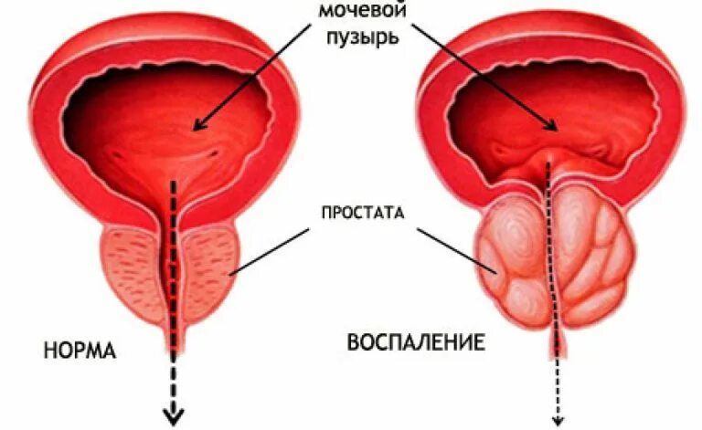 Простатиты симптомы и лечение фото Хронический простатиты у мужчин признаки симптомы лечение. Хронический простатит