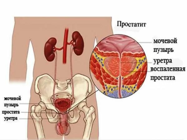 Простатиты симптомы и лечение фото Узи предстательной железы фиброза