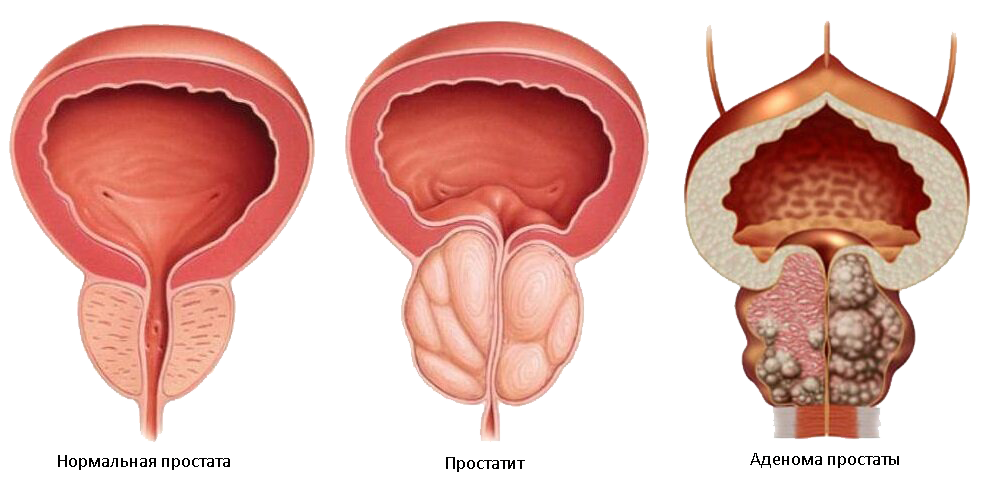 Простатиты симптомы и лечение фото Лечение рака предстательной железы в клинике OncoCareClinic 308
