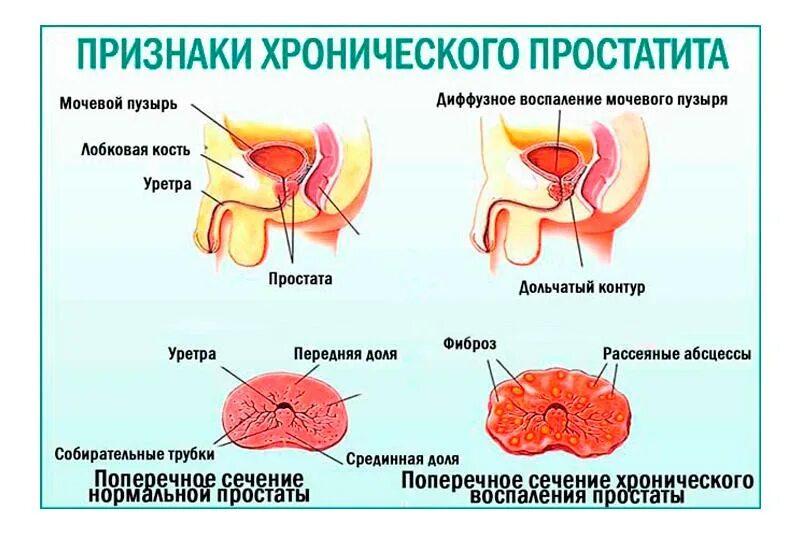 Простатиты симптомы и лечение фото Хронический простатит: причины, симптомы, диагностика и лечение