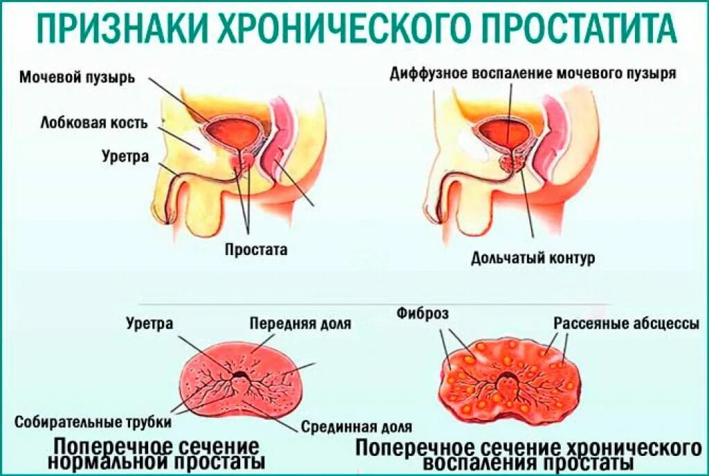 Простатиты симптомы мужчин лечение фото Простаты симптомы признаки