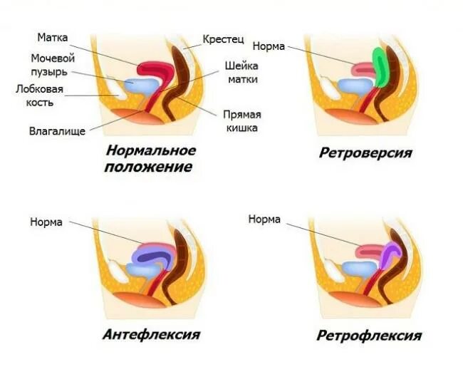 Простейший вариант сделать женское влагалище дома Загиб матки: причины, симптомы и особенности лечения патологии