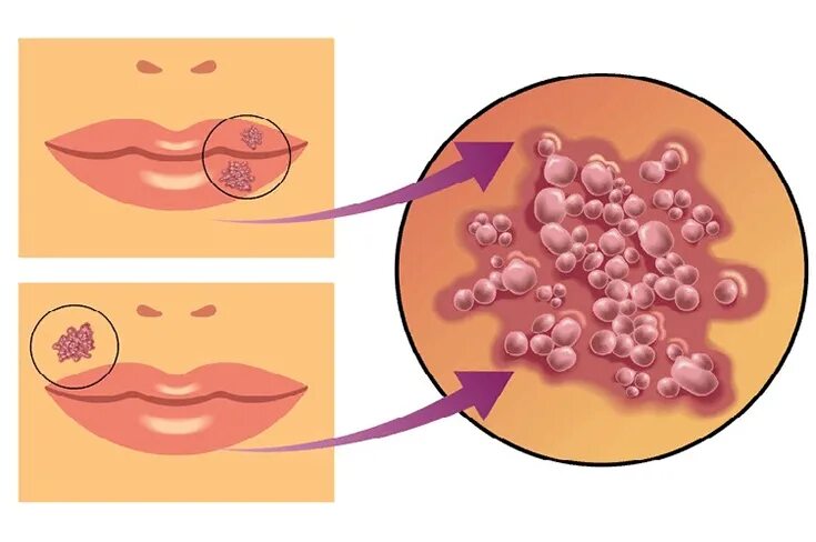 Простой герпес фото Герпес на губах!