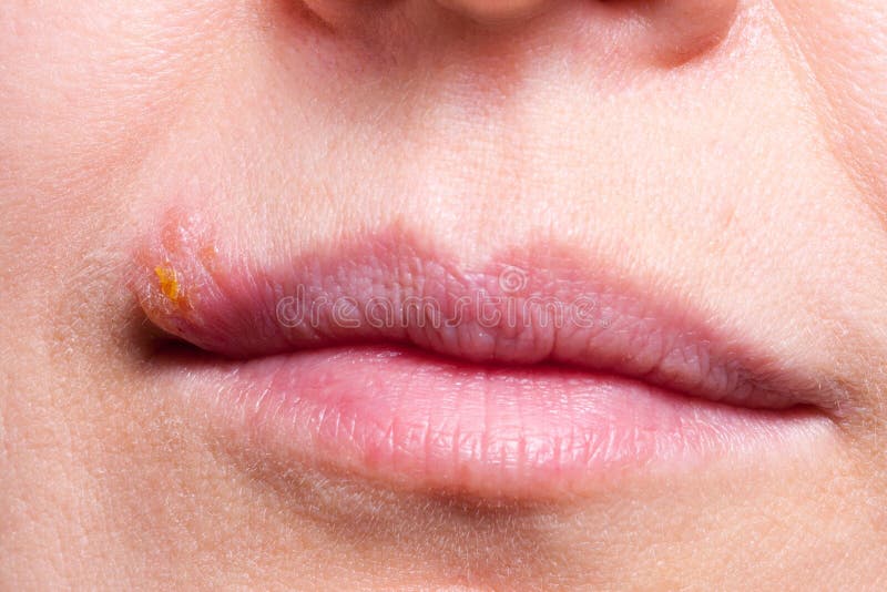 Простой герпес фото Herpes on the Lip Close Up Macro Stock Image - Image of adult, dermatology: 9286