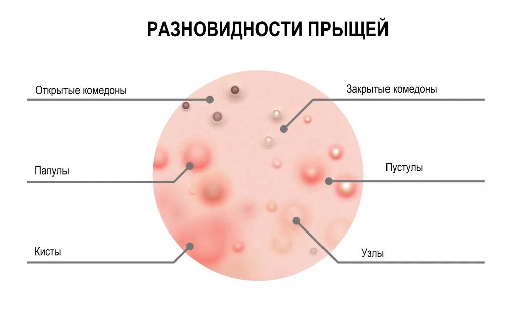 Простой герпес кожи фото Прыщи на лице - причины появления, при каких заболеваниях возникает, диагностика