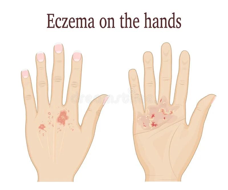 Простой герпес на руках фото Hand Eczema Stock Illustrations - 1,799 Hand Eczema Stock Illustrations, Vectors