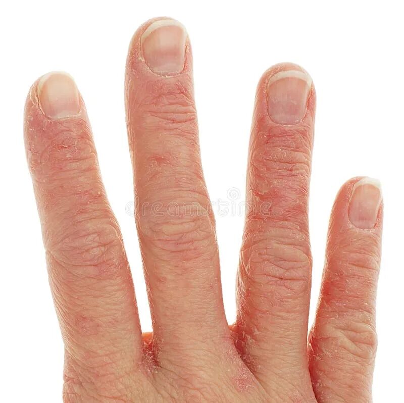 Простой герпес на руках фото Closeup of Eczema Dermatitis on Fingers Stock Image - Image of health, healthcar