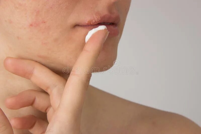 Простой герпес на руках фото Herpes with Pus on the Lips of a Young Girl and Pimples on the F Stock Photo - I