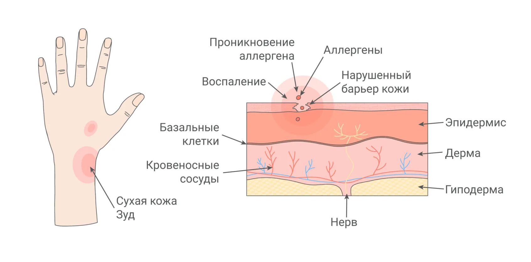 Простой контактный дерматит фото Аллергический контактный дерматит: всё о лечении