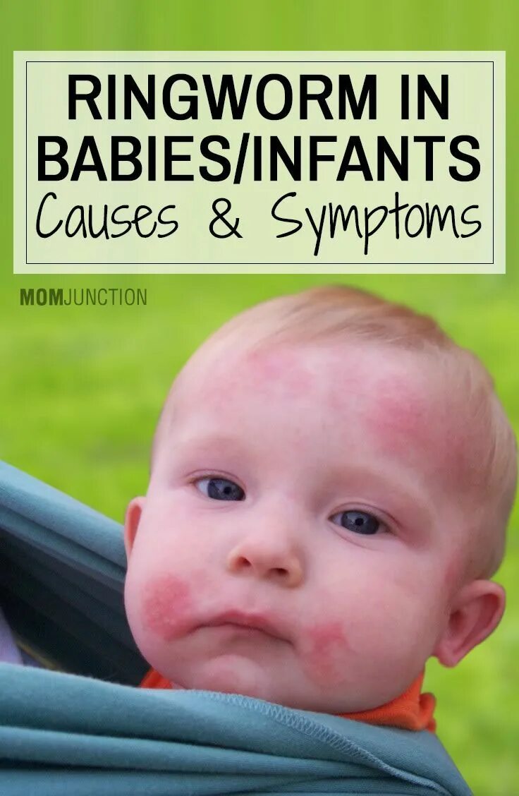 Простой лишай у детей фото Ringworm In Babies Or Infants - 4 Causes & 8 Symptoms You Should Be Aware Of #ri