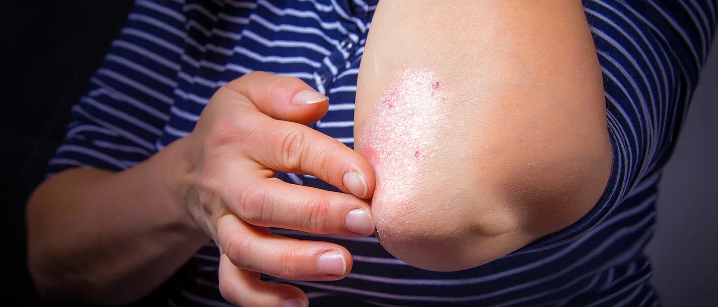 Простой псориаз фото Dermatology's Neil Korman weighs in on effects of plaque psoriasis