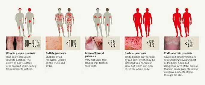 Простой псориаз фото Pin auf Health