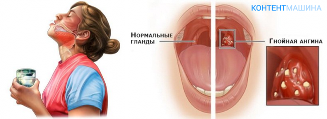 Герпетическая ангина у беременных - почему возникает и что с этим делать? О детс