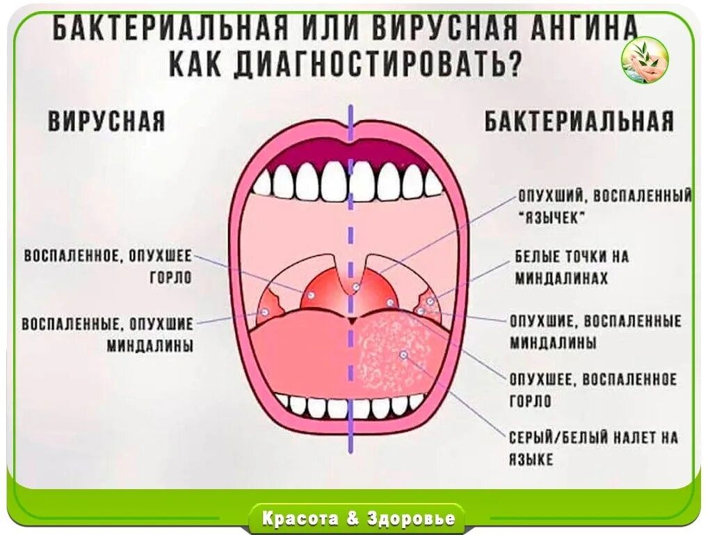 Простуда в горле фото Ангина сколько дней держится температура у детей - найдено 82 картинок