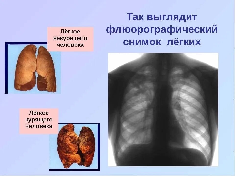 Простые легкие фото Приглашаем Вас пройти ежегодное флюорографияеское исследование! Данное исследова