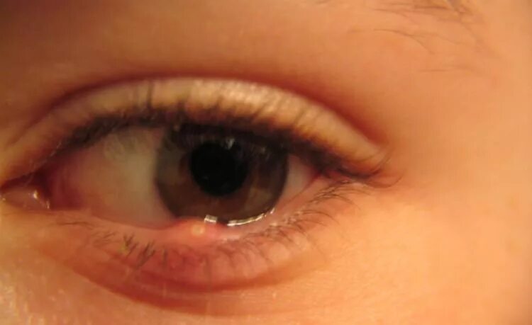 Просянка на веке фото как лечить Have a Lump on Your Eye? Here's What It Could Mean TipHero