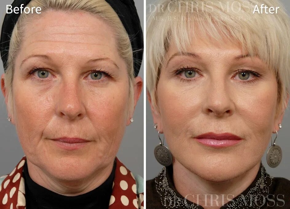 Процедура биоревитализация лица отзывы фото Face Lift & Neck Lift Results - Before and After Face lift surgery, Facelift, Ch