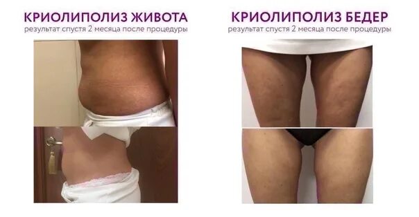 Процедура криолиполиза фото до и после Cryolipolysis ! Looking for models ! !! 1 procedure (2 nozzles) - 2800 RUB (inst