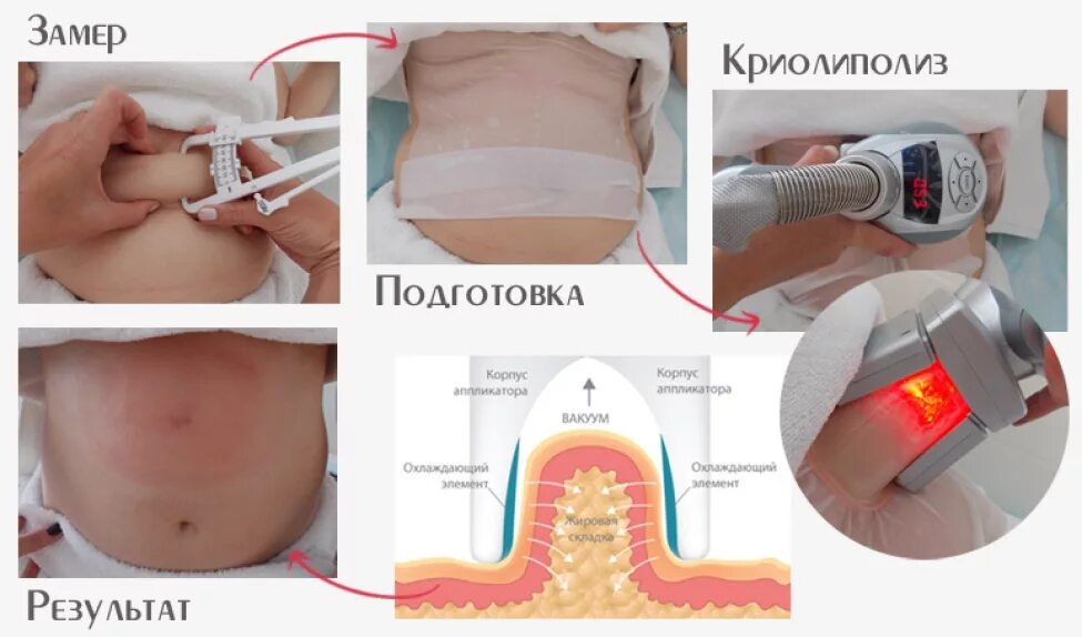 Процедура криолиполиза фото до и после Что это такое криолиполиз: суть процедуры