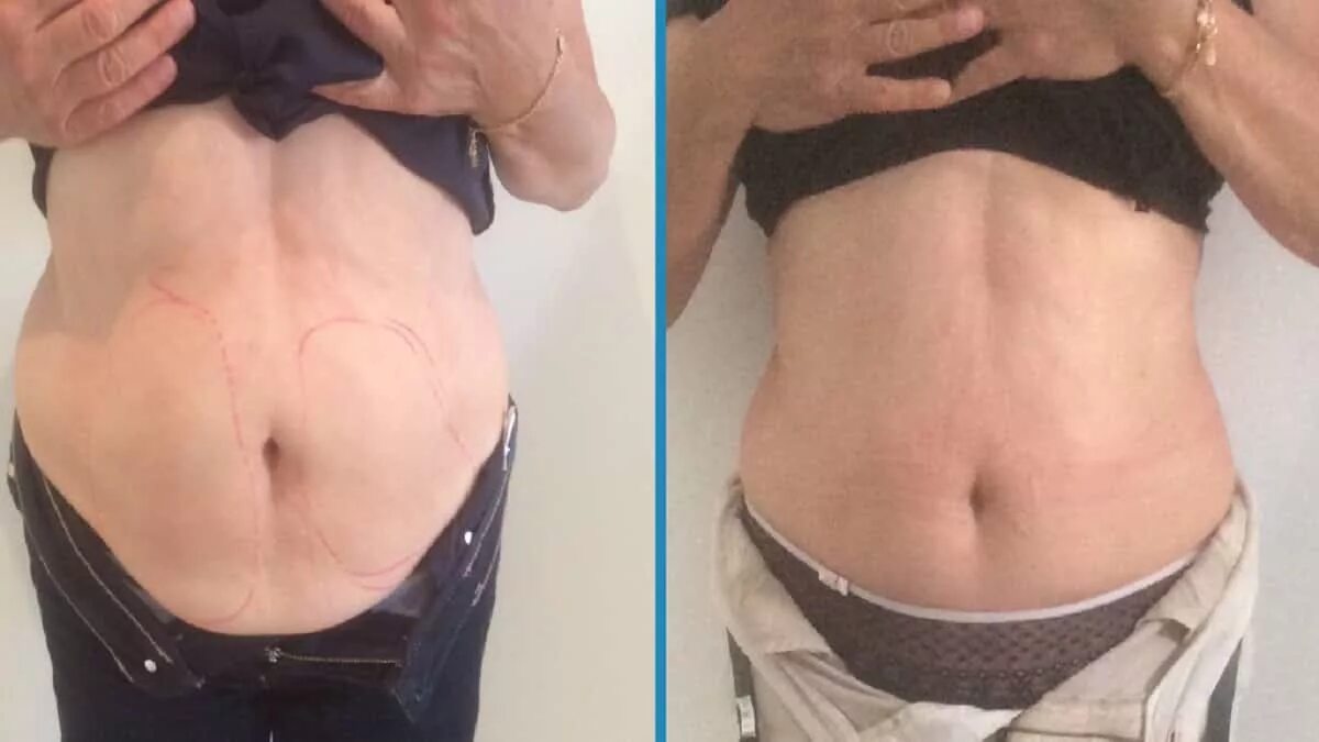 Процедура криолиполиза фото до и после Cryolipolysis - Lux Medicus