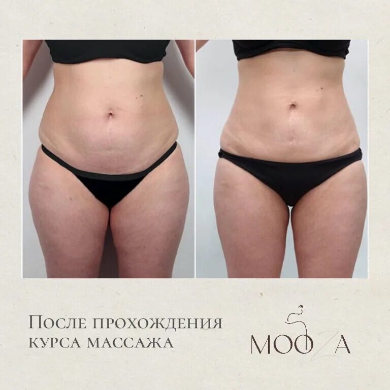 Процедура криолиполиза фото до и после Permanently closed: Mooza, massage salon, Republic of Bashkortostan, Ufa, Zaki V