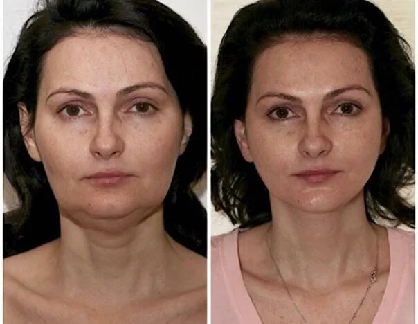 Процедура смас фото до и после Need models for face rejuvenation procedure for FREE: SMAS-lifting. Results for 