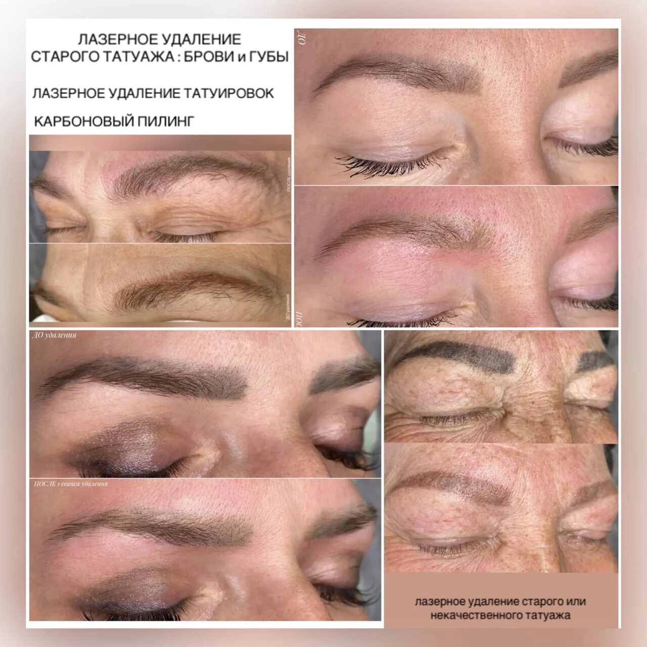 Процедура удаления татуажа ⚜ LASER REMOVAL OF OLD TATTOO /INQUAL TATTOO removing an old eyebrow/lip tattoo 