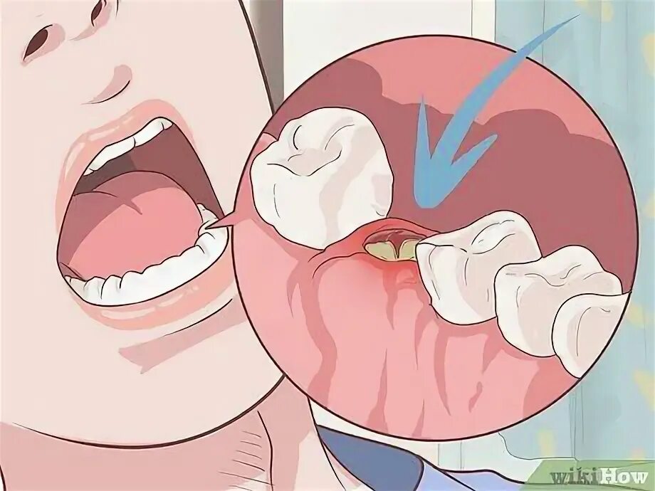 Процесс удаления зуба фото Effective Tooth Extraction Aftercare Tips for a Healthy Recovery