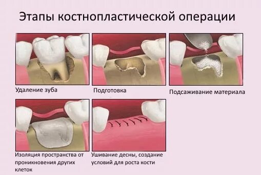 Процесс удаления зуба фото Наращивание костной ткани при имплантации зубов в Санкт-Петербурге