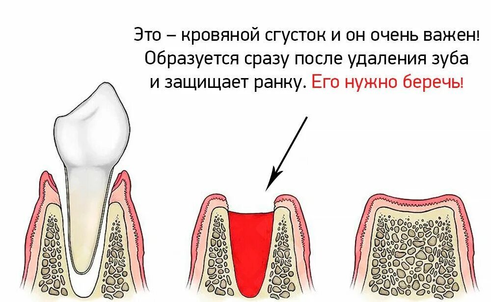 Процесс удаления зуба фото Что делать после удаления зуба - стоматологическая клиника Эталон Ростов